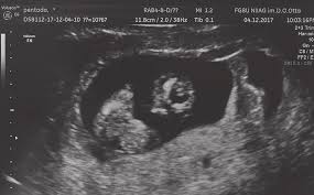 Conception occurs about two weeks from this day, and that's when you're truly considered pregnant. 10 Weeks 6 Days Of Pregnancy Echogram Of The Fetus With Multiple Download Scientific Diagram