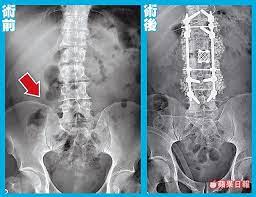 蔡智銘 詹智淵 綜合報導 下背痛竟是細菌在啃骨頭 邱姓大貨車司機日前因為下背疼痛 前往國軍台中總醫院檢查 赫然發現罹患罕見血行性脊椎膿瘍 medical news medical headlines