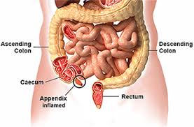 Lower gastrointestinal bleeding, commonly abbreviated lgib, is any form of gastrointestinal bleeding in the lower gastrointestinal tract. Home Remedies For Appendicitis Natural Treatment