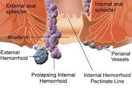 Hemorrhoids prolapse when their blood vessels the thrombosed hemorrhoid may heal with scarring, and leave a tag of skin protruding in the anus. Internal And External Hemorrhoids Symptoms Treatment Pictures Causes