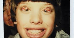 Why did people flip their eyelids inside out?