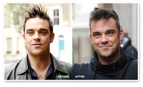 Robbie Williams Hair Transplant New Hairline Hair Transplant Hair Loss Men Losing Hair Women