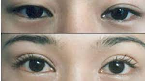 Dn.beauty natural 65.188 views3 months ago. How To Fix Uneven Eyelids Without Surgery Youtube