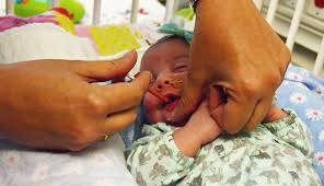 Essential nutrients cannot be synthesized in the organism, either at all or not in sufficient quantities, and therefore must be obtained through the diet. Higher Doses Of Vitamin D Increase Bone Density In Premature Babies Unmc