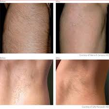 laser hair removal for all body parts