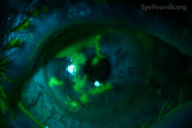 Hsv keratitis is a major cause of blindness worldwide 1. Hsv Keratitis Eyerounds Org Online Ophthalmic Atlas