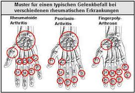 Medizinfo Krankheitsverlauf Der Rheumatoiden Arthritis Chronischen Polyarthritis