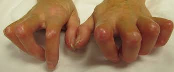 Image result for Systemic Sclerosis