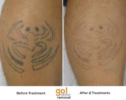 Tattoo removal has been performed with various tools since the start of tattooing. Stick And Poke Tattoos Almost Always Come Out Quickly Averaging Just 2 5 Treatments For Full Removal This One Laser Tattoo Tattoo Removal Cream Tattoo Removal