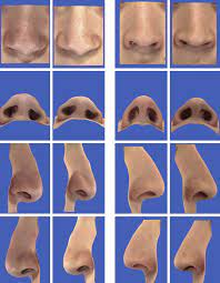 From earlier nosethrill, from middle english nostril, nostrel, nosterl, nosthirl, nosethril, nosethirl, noosthril, nosethyrl, nosethurl, nesethirl, nesthyrylle, nasethirl, nesethrull, from old english nosþȳrel, equivalent to nose +‎ thirl (hole). Does The Nostril Shape Change After Le Fort I Advancement In Patients With Unilateral Complete Cleft Lip Journal Of Oral And Maxillofacial Surgery
