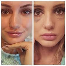 Straightening the Bone