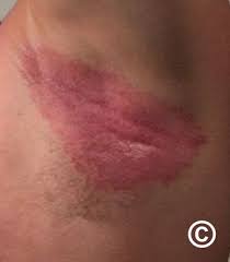 Image result for Erythrasma