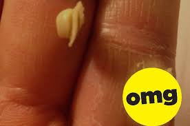 14 Pimple Popping Posts That Ll Gross You Tf Out Pimple Popping Pimples Acne Scar Removal