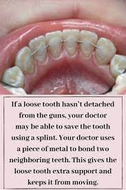 Splinting Teeth Dental Dentist Dentistry Smile Teeth Dental Dentistry Teeth Bonding