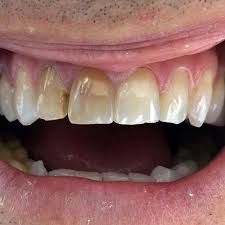 Most of the clinics listed on this website offer a free exploratory consultation for prospective implant patients. Santos Dental Stage Smile Designers