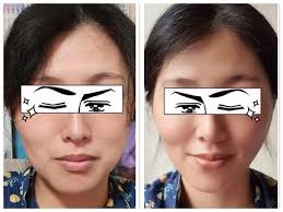 7/10臉部埋線各兩條＋補一點唇本來很害怕埋線怕臉會爛掉，不過做完的時候真的很喜歡，以前出門的時候老是被認為快4＝(╥﹏╥)但我才快30而已啊啊啊～  真的還好有去做，讓自己更有自信了