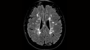 Image result for Brain Lesion