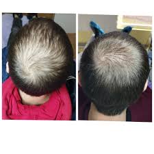 ✓თმა ერთ-ერთი მნიშვნელოვანია ჩვენთვის. 👉🏼და გაწუხებს ხშირი თმის ცვენა?  👉🏼საგრძნობლად შეგითხელდათ? ✓უკვე შენ შეგიძლია დროულად შეაჩერო ...