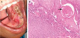 Image result for spinocellular carcinoma of the oral cavity