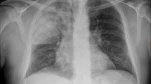 Pneumonia is an infection in one or both lung. Pneumonia Vall D Hebron Barcelona Hospital Campus