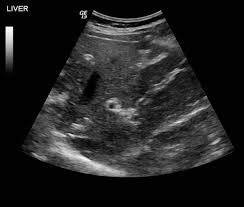 Periportal Fibrosis Thickening Of The Walls Of The Portal Vein And Its Central And Peripheral Branches Indicative Of Periportal Fibrosis Liver Wall Veins