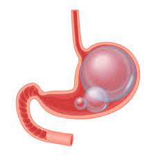 One of the best ways to get rid of gas and the accumulation and find relief from the bloat is to drink hot liquids. How To Get Rid Of Gas After Upper Endoscopy