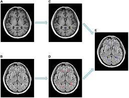 Frontiers | The Application of Diffusion Kurtosis Imaging on the  Heterogeneous White Matter in Relapsing-Remitting Multiple Sclerosis