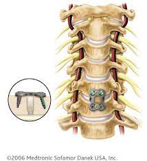 Osteochondrose Therapie Dr Tuschel