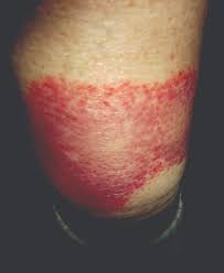 This is a skin rash that usually affects females who are younger than fifteen years of age. How To Recognize And Manage Granuloma Annulare