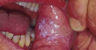 Image result for oral thrush symptoms roof of the mouth
