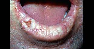 Tanda dan simptom kanser mulut. Kanser Mulut Punca Simptom Dan Rawatan The Diagnosa