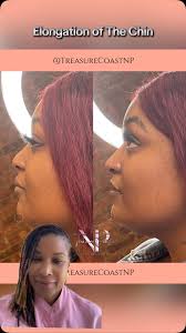 Subtle transitions: chin filler, pixie nose job (non-surgical rhinoplasty),  and masseter Botox (for facial slimming), Take that step & Book your  consultation with LaToya today @TreasureCoastNP (on all ...