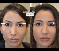 Upper Blepharoplasty Beverly Hills