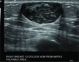 Epidermoid cysts represent the most common cutaneous cysts. Epidermoid Cyst In Male Patient Mimicking A Suspicious Breast Mass And Consequences Of Biopsy Journal Of Clinical Imaging Science