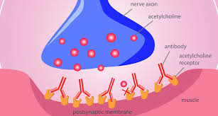 The most commonly affected muscles are those of the eyes, face, and swallowing. Immunsuppressive Therapie Gegen Myasthenia Gravis Auch Bei