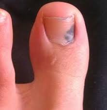 If your toenail turns black, it's most likely a bruise under the nail, technically called a subungual hematoma. Toenail Subungal Melanoma Symptoms Causes And Treatments