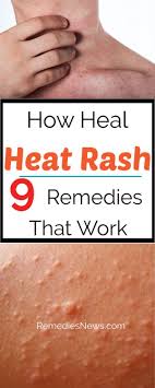 How To Get Rid Of Heat Rash Quickly 9 Remedies To Heal Heat Rash That Work If You Having Sunburn This Heat Rash Heat Rash Treatment Home Remedies For Rashes