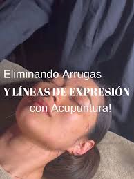 Beneficios de la apicultura con agujas para relajación