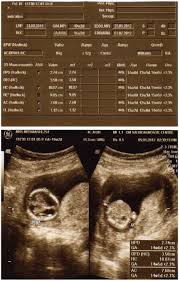 Image result for First Trimester Ultrasound