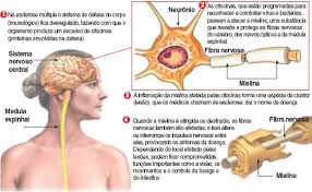Esses sintomas aparecem em metade dos pacientes com esclerose múltipla. Esclerose Multipla