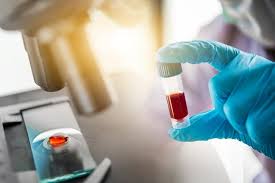 That depends on a few different factors, the most… how thc blood tests work, and what you should know. Antibody Tests May Hold Clues To Covid 19 Exposure Immunity But It S Complicated Cidrap