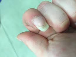 Schwarze Striche Unter Dem Fingernagel Soll Ich Zum Arzt Gesundheit Nagel