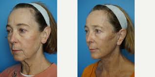 Benjamin C. Marcus, MD, Board Certified Facial Plastic Surgeon