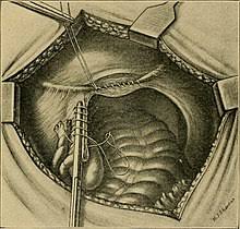 Postpartum livmor infeksjon mens mange kvinner er bekymret for komplikasjoner under svangerskapet, kan komplikasjoner også oppstå etter fødsel, inkludert postpartum livmor infeksjon. Parametritt Parametritis Qaz Wiki