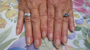 Nagelpilz Am Finger Das Konnen Sie Dagegen Tun Focus De