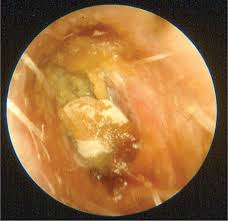 Image result for Acute Otitis Externa