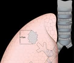 De er også dannet på bakgrunn av økende konsentrasjoner av hyperandrogenisme av binyrene utvikles på grunn av tilstedeværelsen av tumorer dannet i binyrene. Stadier Og Spredningsmonster Ved Lungekreft