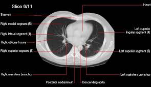 Ct scan sangat digunakan pada. Apa Itu Ct Scan Thorax Ct Scan Machine