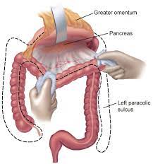 Stomach cancer is an abnormal growth of cells that begins in the stomach. Gastric Cancer Prevention And Treatment Of Peritoneal Metastases
