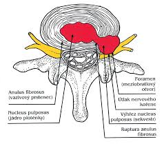 Image result for vyhřezlá ploténka
